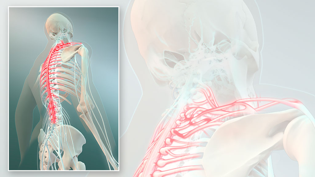 Steve Santer - 3D illustration medical - Nerve Pain